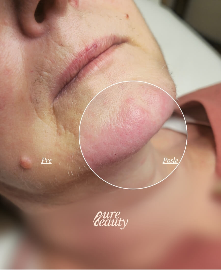 Pre I Posle Elektroliza 03 (1)