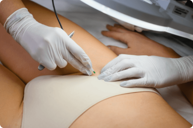 Elektroliza Bikini Zona (1)